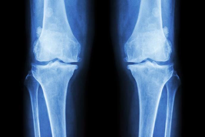 骨关节炎成像:一项调查的英国哥伦比亚医生和以证据为基础的建议188bet体育官方网站